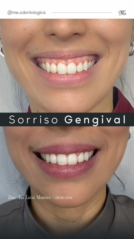 Correção de sorriso gengival — antes e depois na ME Odontologia